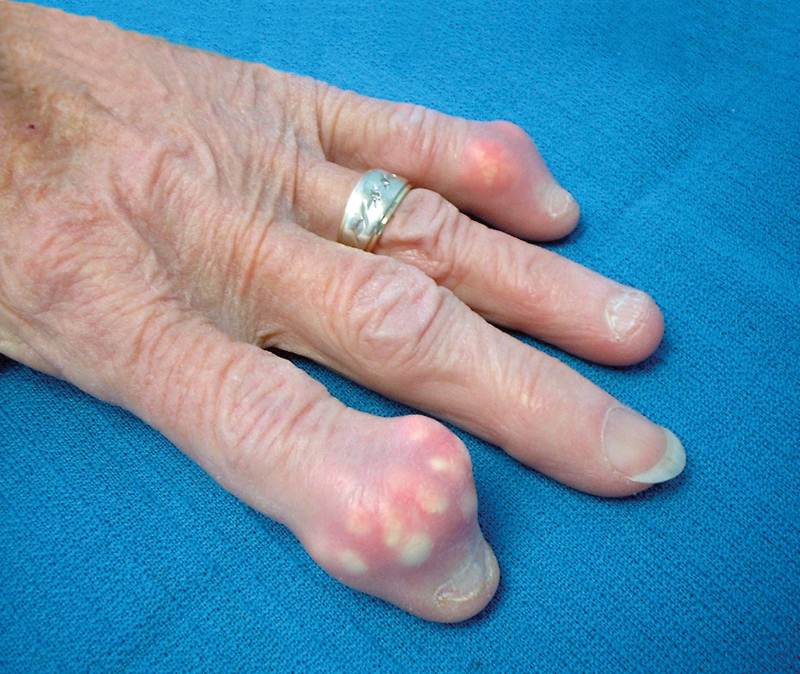 Gout on the fingers photos