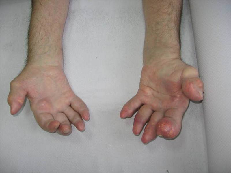 Gout on the hands photos