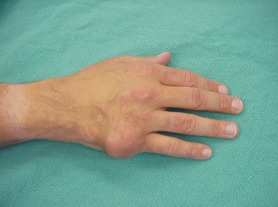 Gout on the hands pictures