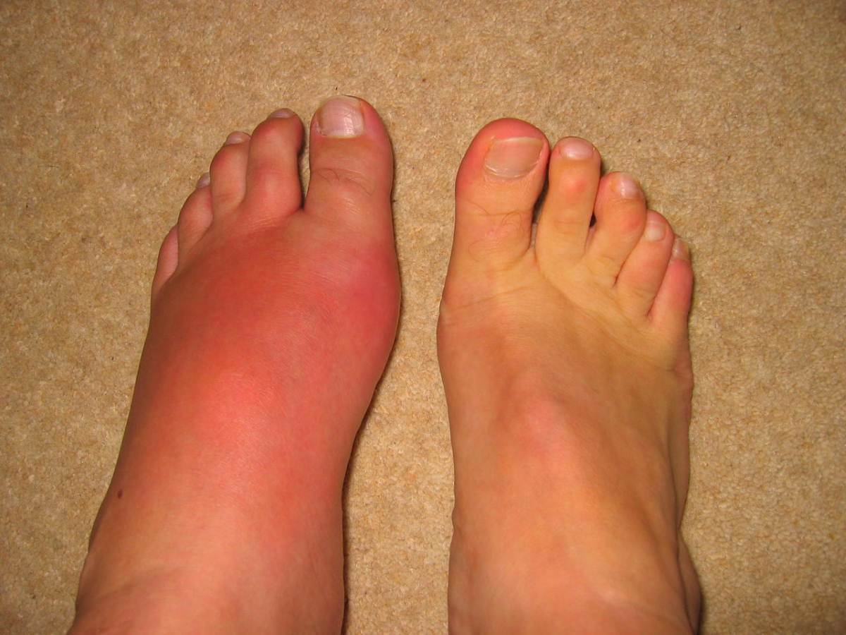 Gout On The Legs Photos Symptoms And Pictures 2118
