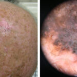 Can melanoma look like a blackhead