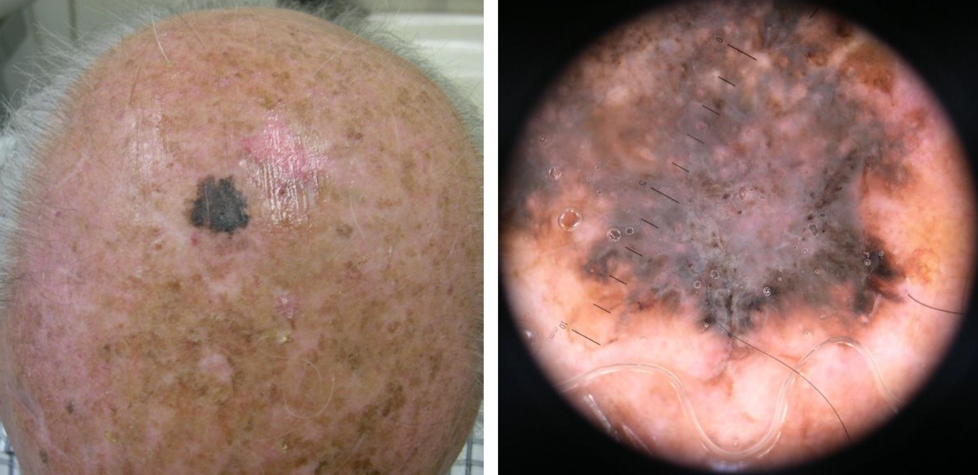 Can melanoma look like a blackhead