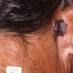 Ear melanoma pictures 2