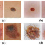 Early melanoma images