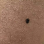 Early melanoma photos