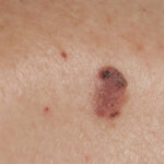 Early melanoma pics