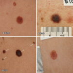 Early melanoma pictures