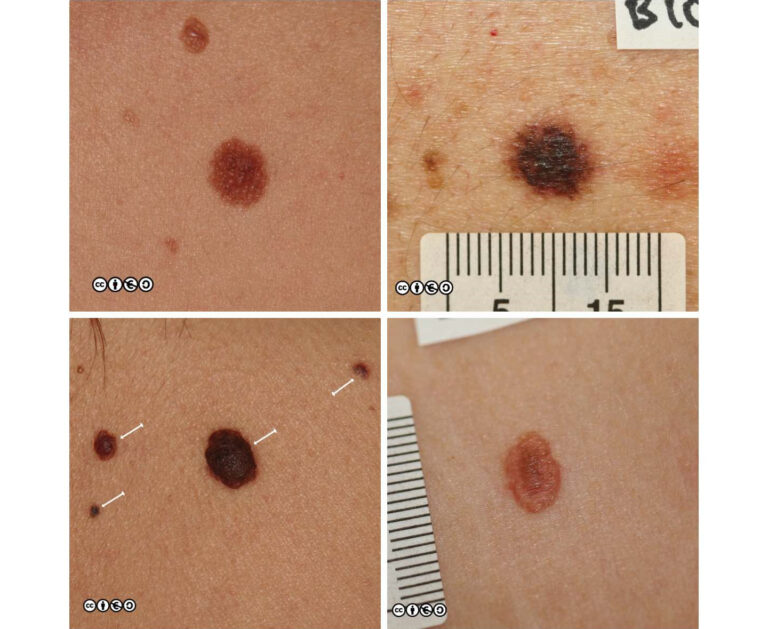 Melanoma images early stages, melanoma pictures early stages, early