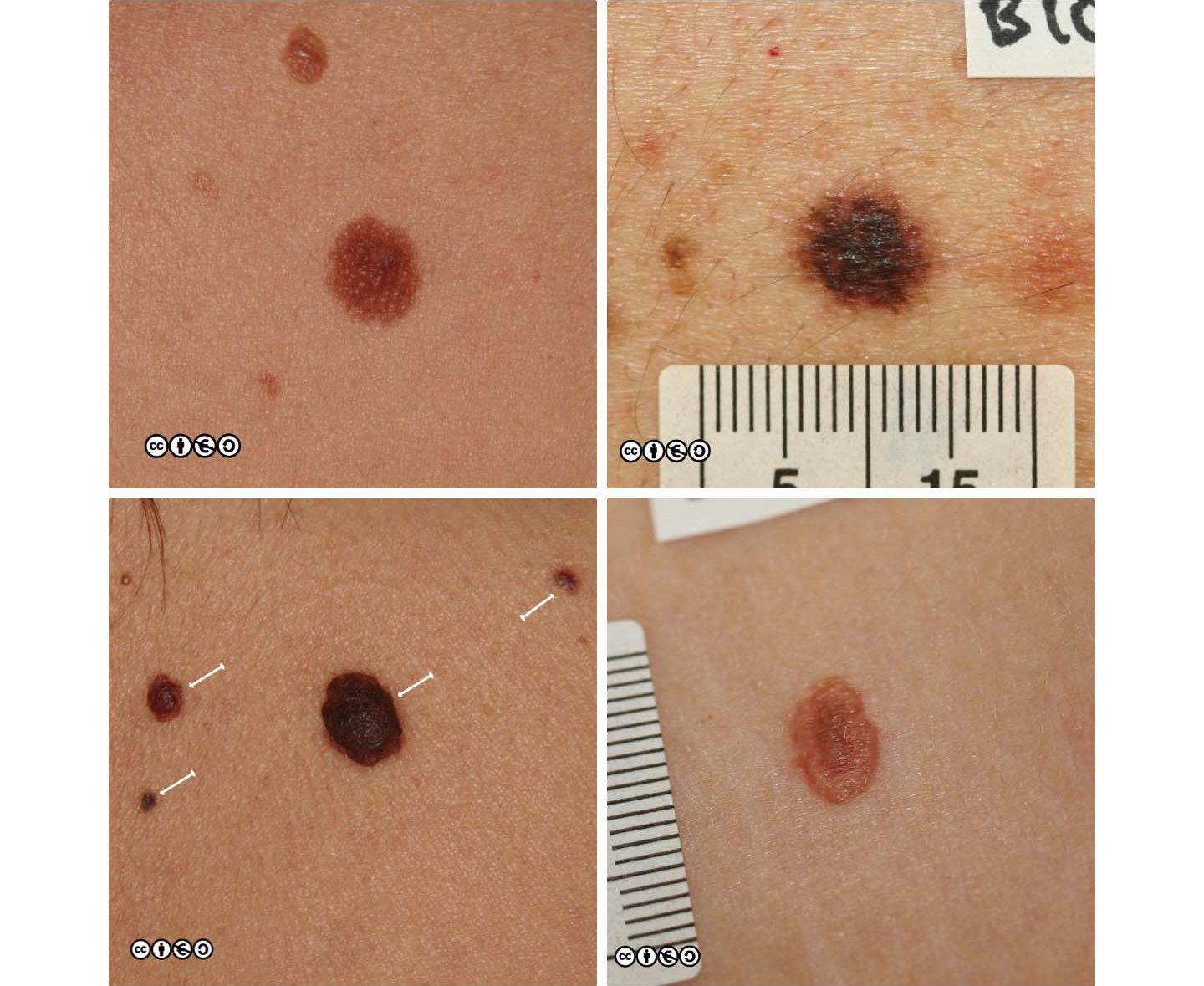 Melanoma Skin Cancer Stages