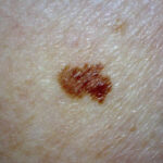 Early stage melanoma cancer pictures