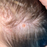 Early stage melanoma on scalp pictures