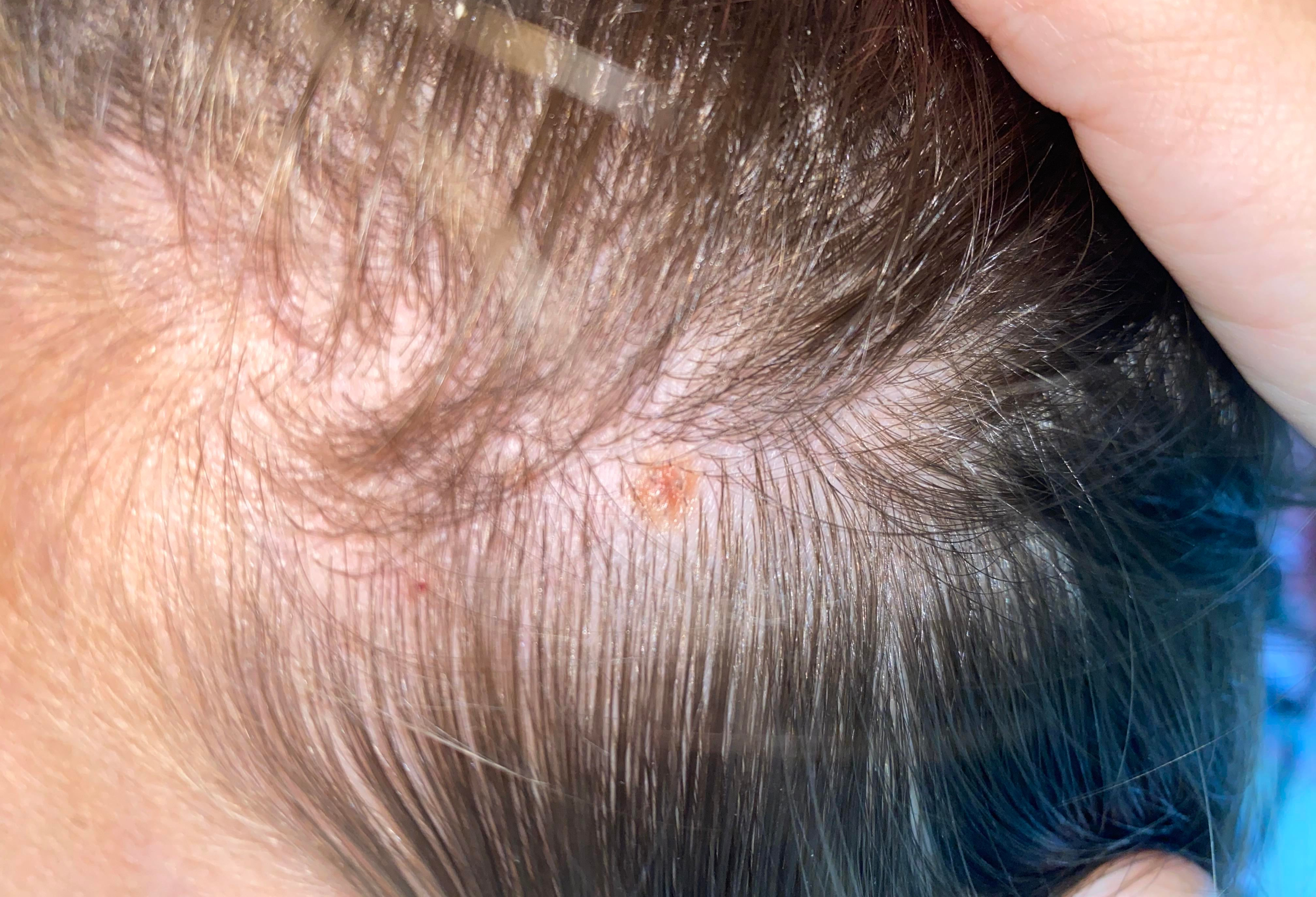 Early stage melanoma on scalp pictures
