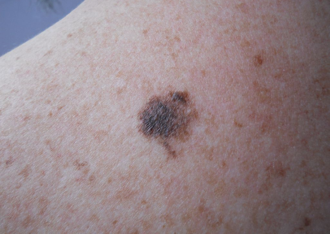 early-superficial-melanoma-hot-sex-picture