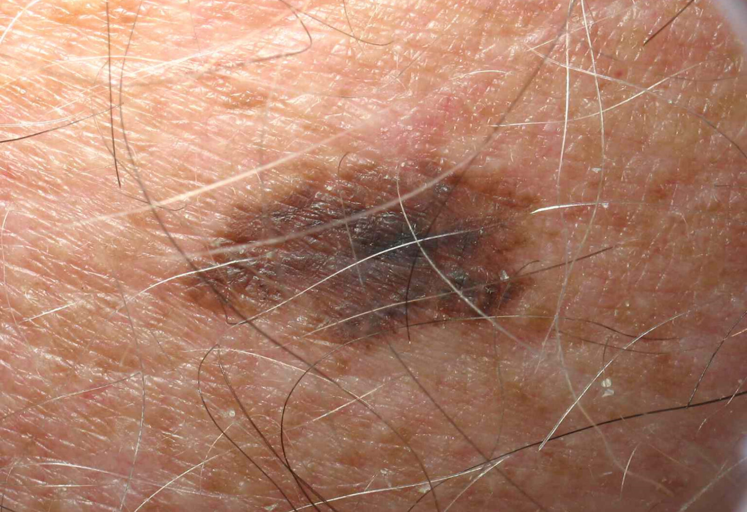 late-stage-melanoma-pictures-symptoms-and-pictures