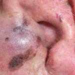 Melanoma ear images