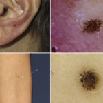 Melanoma ear pictures