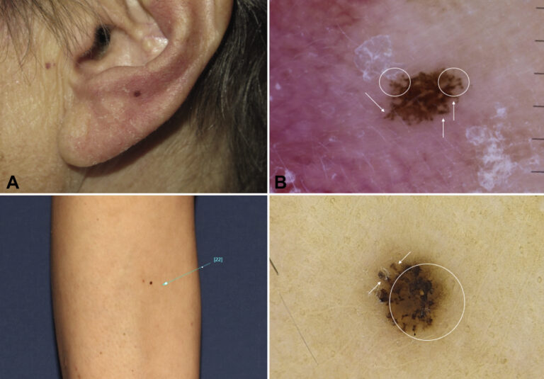 Melanoma ear pictures Symptoms and pictures