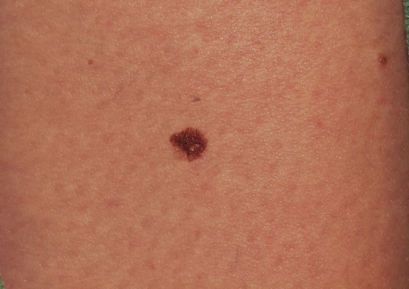 Melanoma early pictures