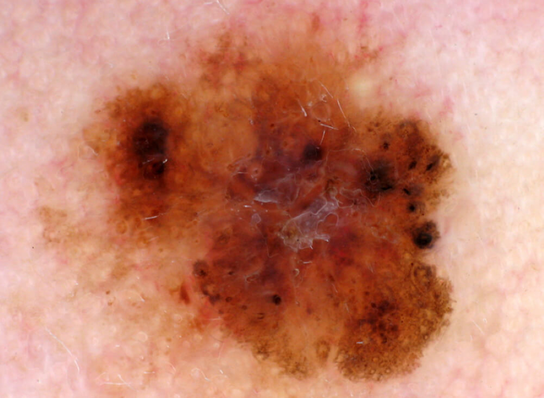 Melanoma early stage skin cancer photos