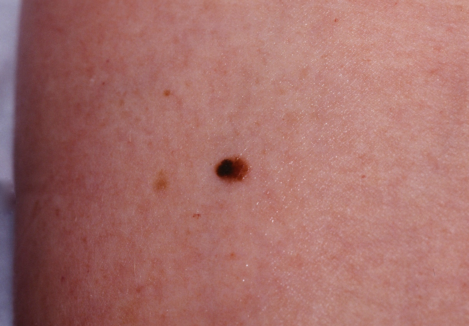 Melanoma early stages images