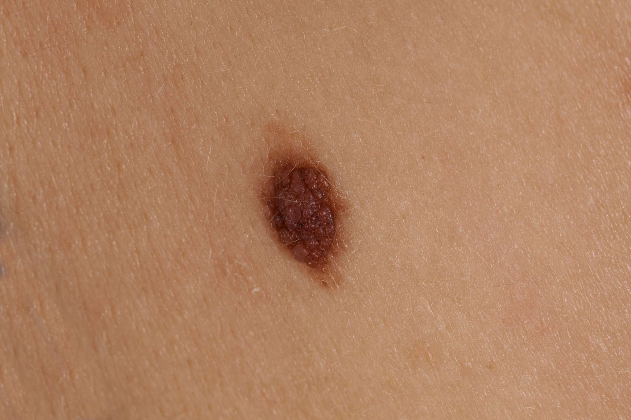 Melanoma early stages photos