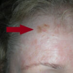 Melanoma forehead pictures