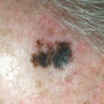 Melanoma hairline photos