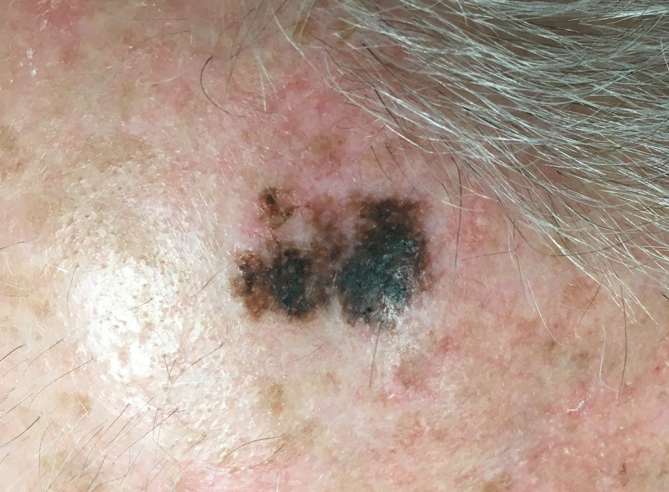 Melanoma hairline photos
