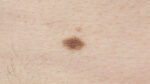 Melanoma Images Early Stages, Melanoma Pictures Early Stages, Early ...