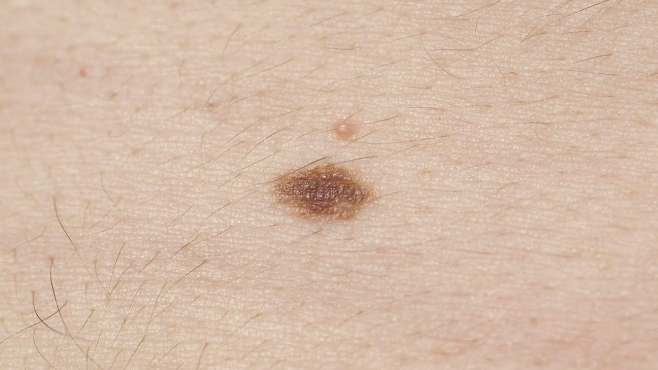 melanoma-images-early-stages-melanoma-pictures-early-stages-early