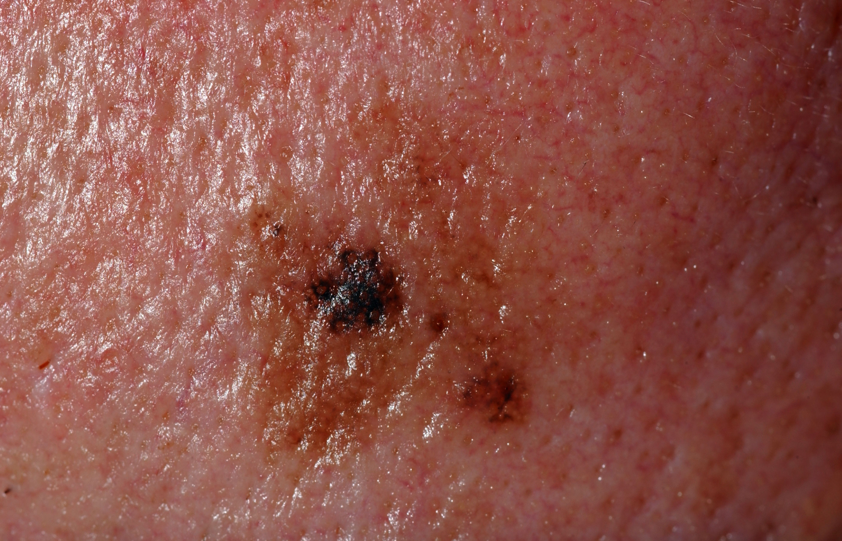 Melanoma in situ photos
