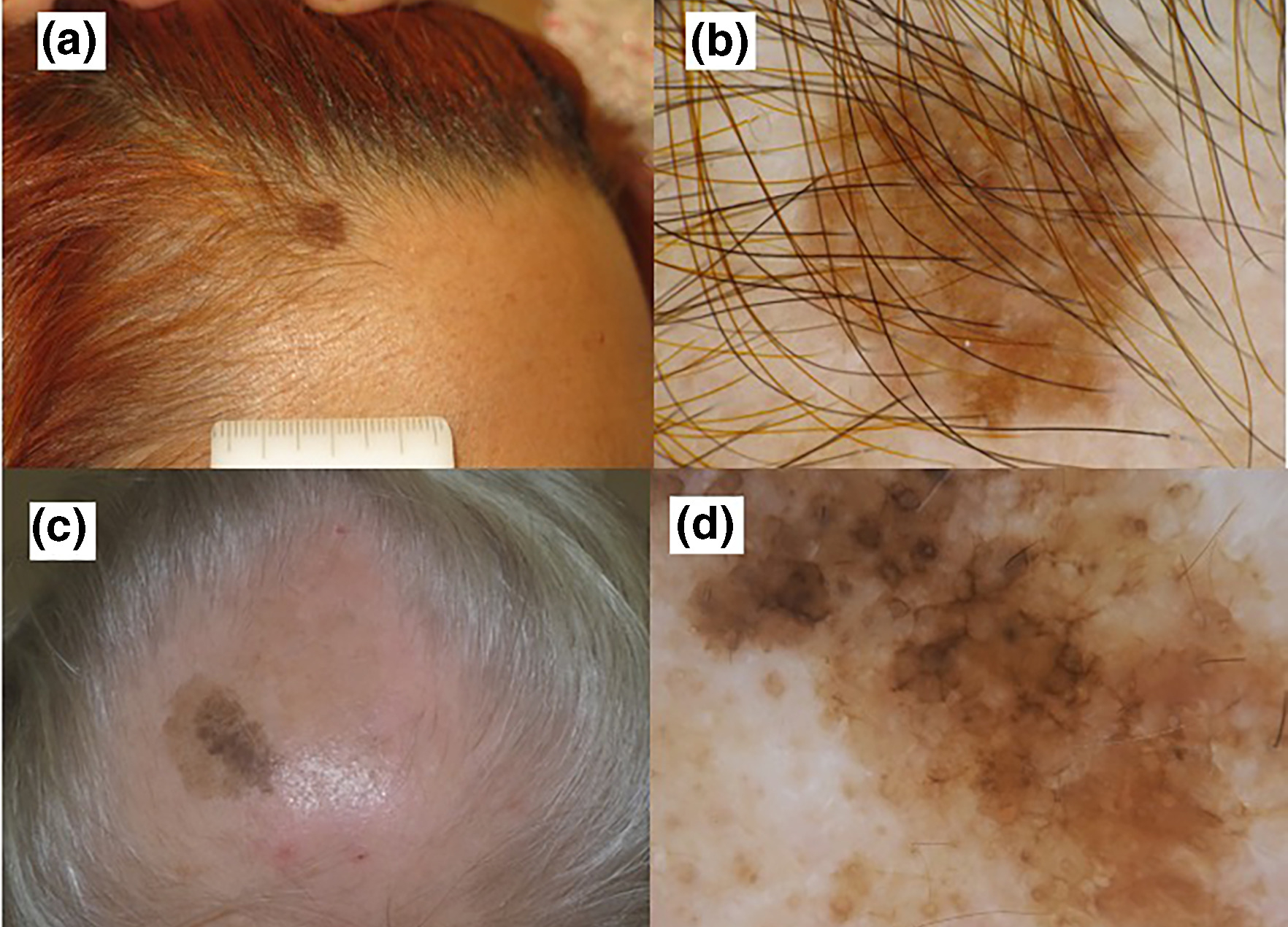 melanoma-scalp