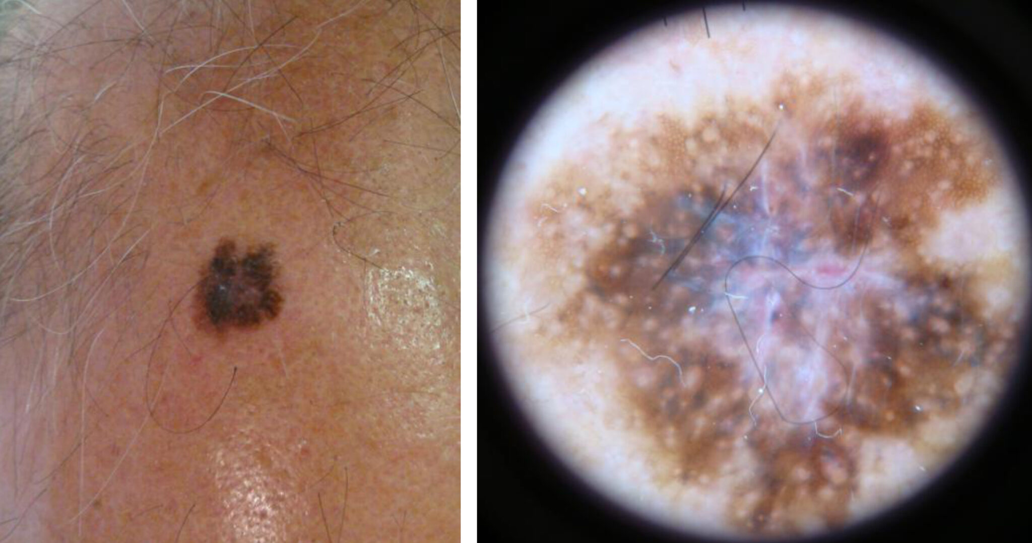 Melanoma On Scalp Pictures Early Stage 1 Scalp Melanoma Images 