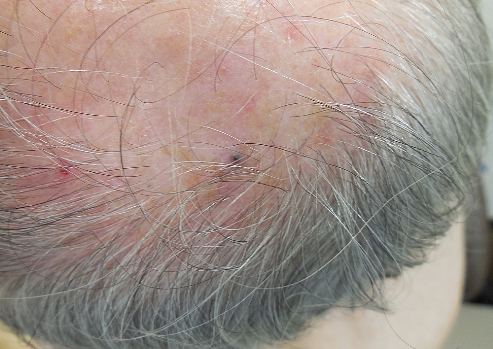 Melanoma on top of head pictures