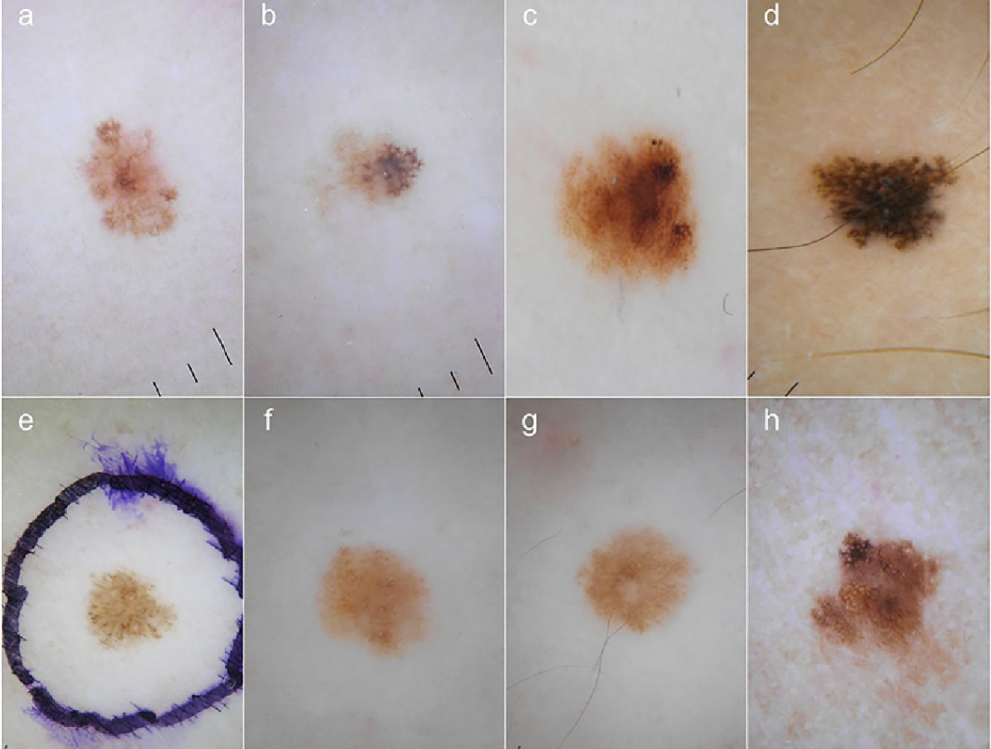 Melanoma Photos Early Stage Symptoms And Pictures
