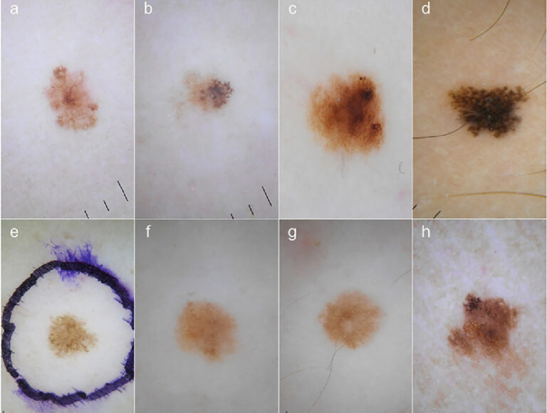 Melanoma Pictures By Stages Symptoms And Pictures 2787
