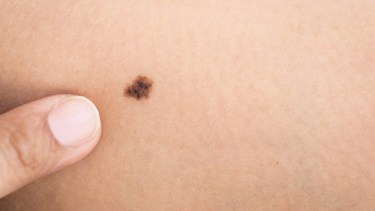 melanoma-survival-rate-treatment-options-and-more