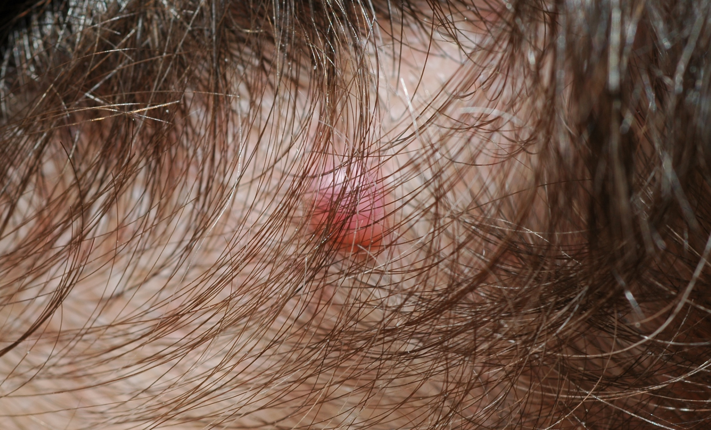 Melanoma pictures on head