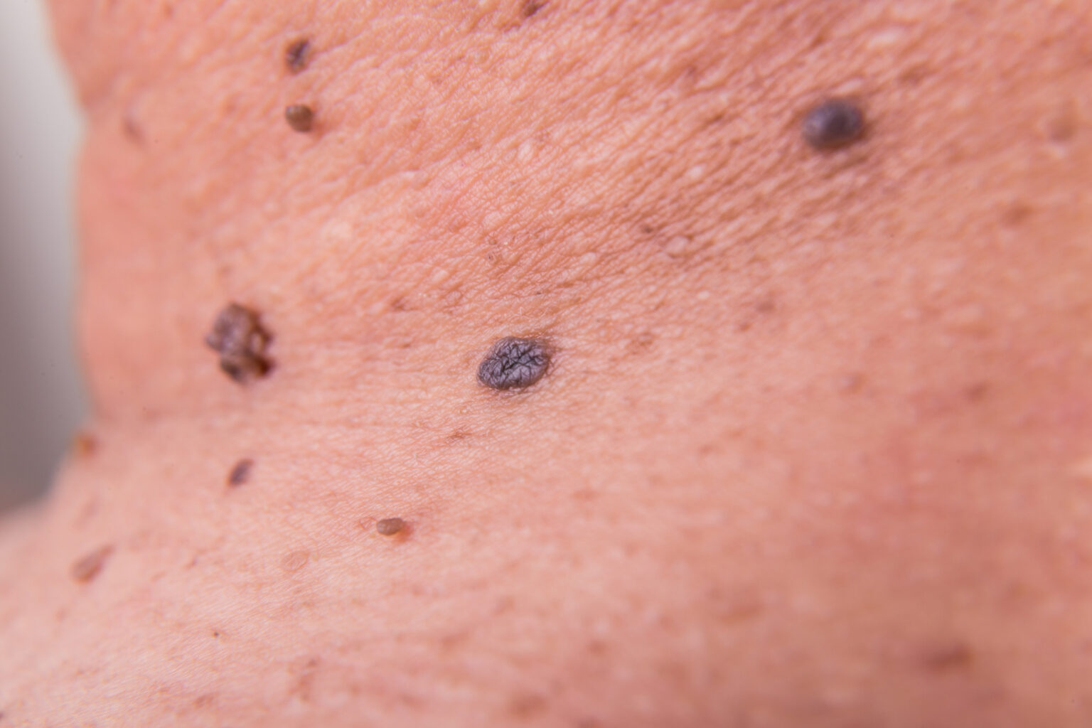 Melanoma pictures on neck | Symptoms and pictures