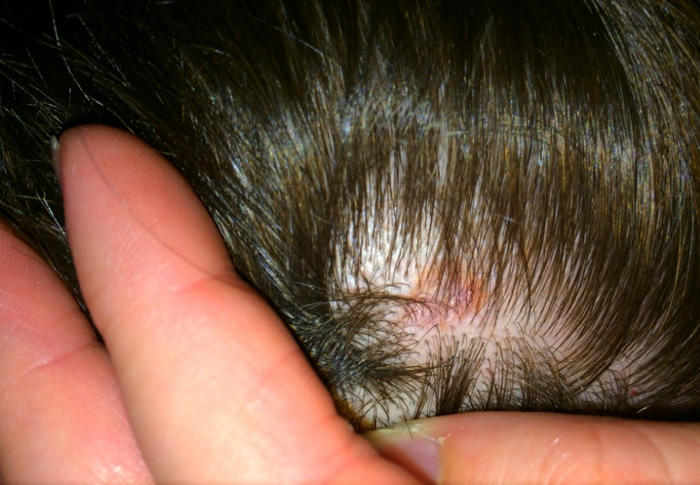 Melanoma pictures on scalp