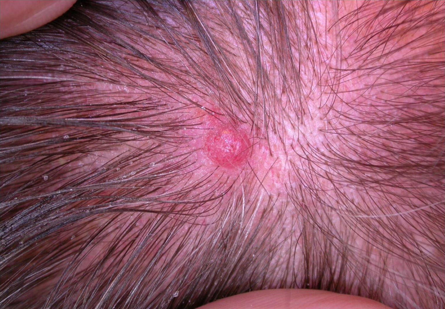 Melanoma pictures scalp | Symptoms and pictures