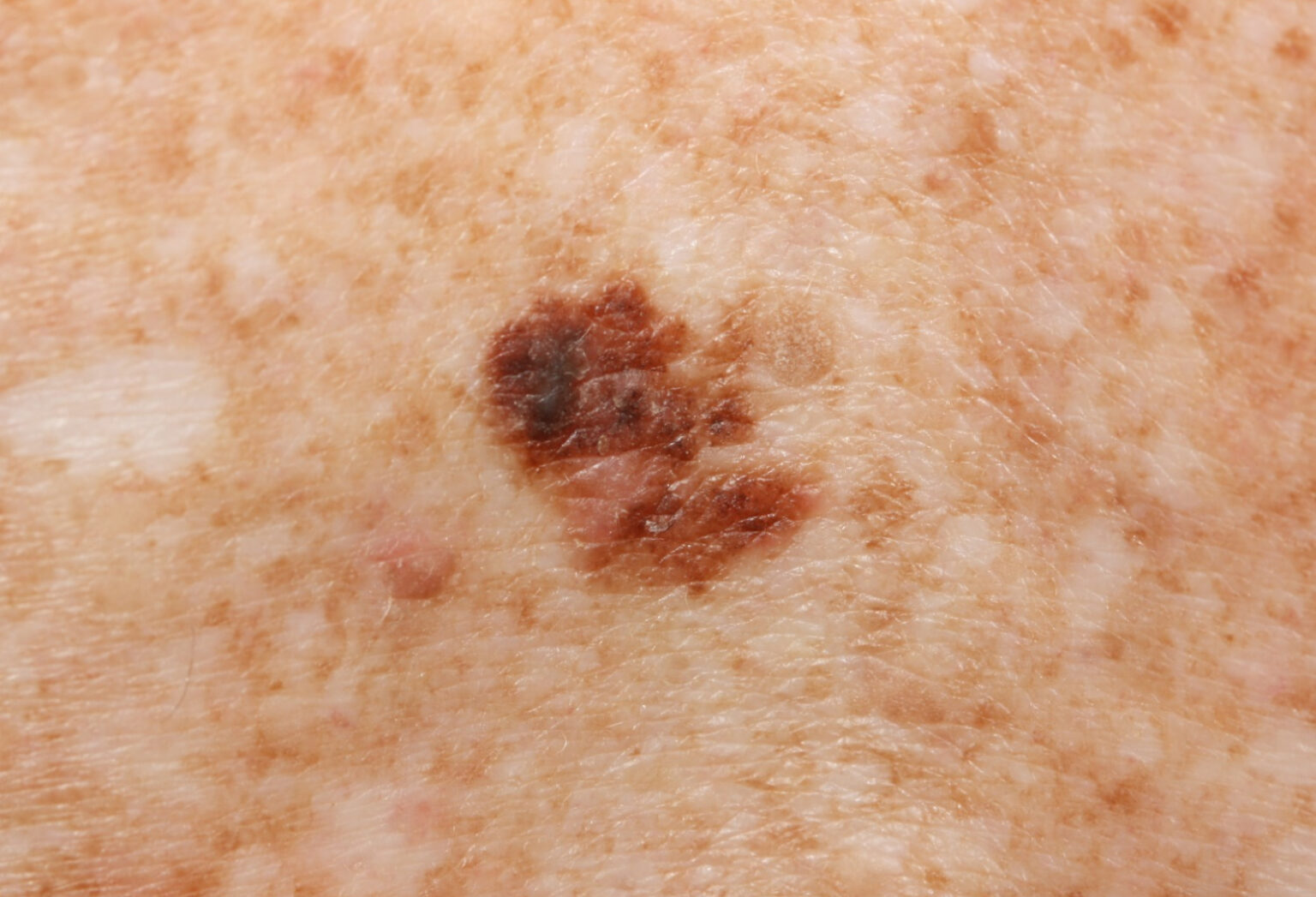 Understanding Stage 2 Melanoma: What You Need To Know