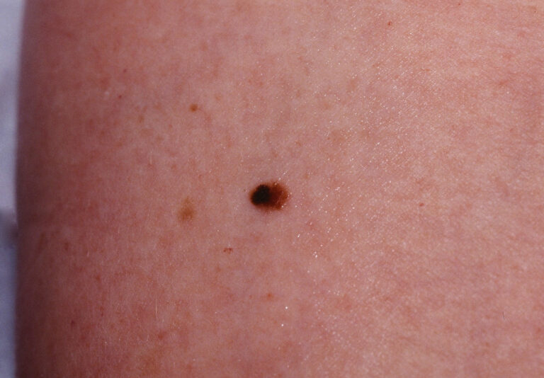 Melanoma Pictures Stage Symptoms And Pictures