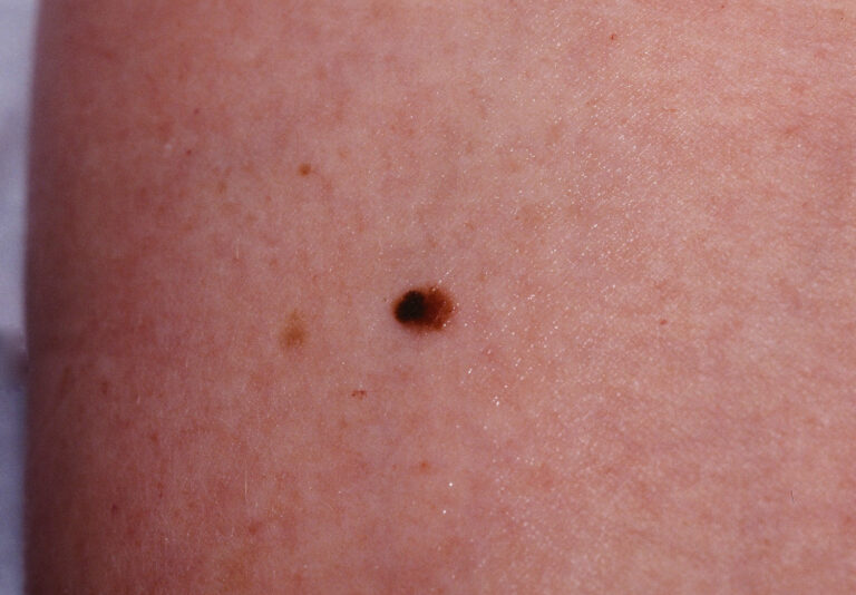 Melanoma pictures stage 4 Symptoms and pictures