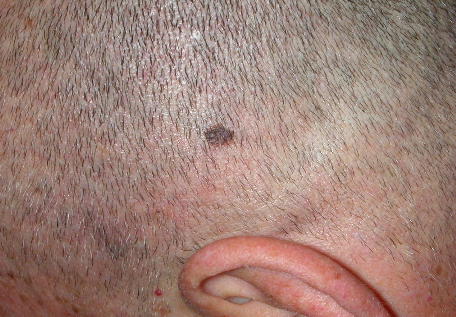 Melanoma Scalp Images Symptoms And Pictures