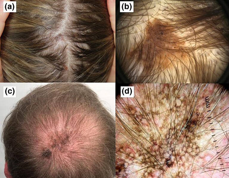 Melanoma Scalp Photos Symptoms And Pictures