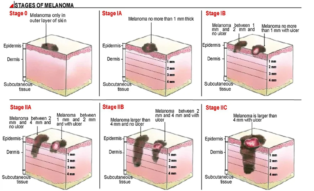 Melanoma stages images