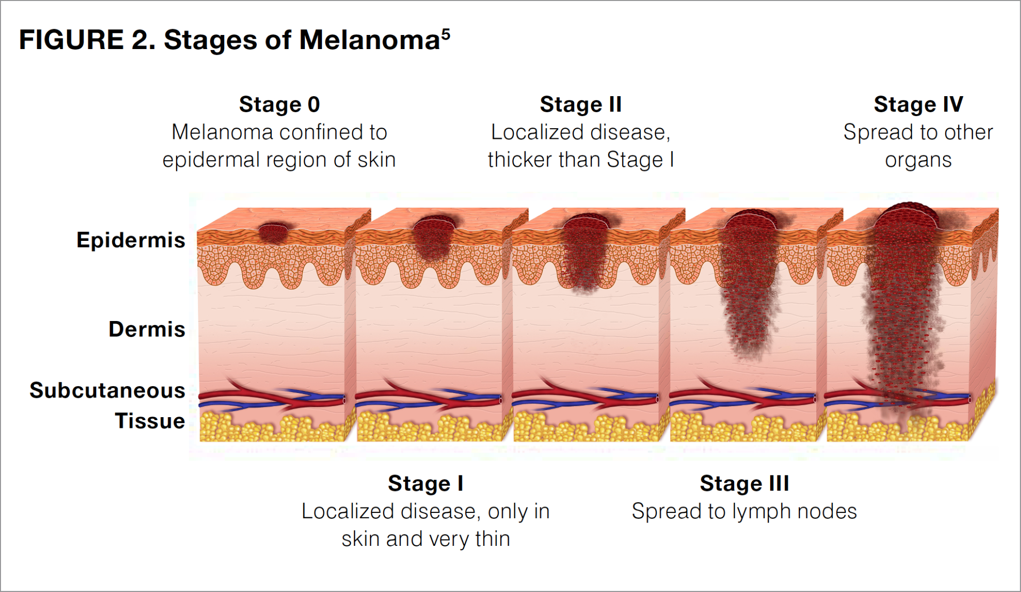 Melanoma Stages Photos 