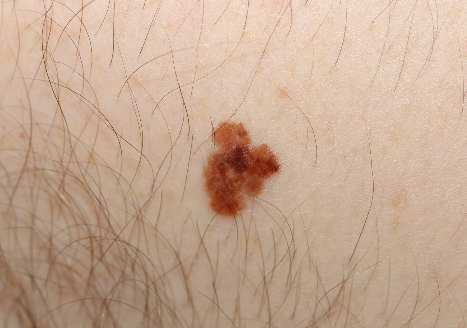 Melanoma symptoms stage 1 pictures