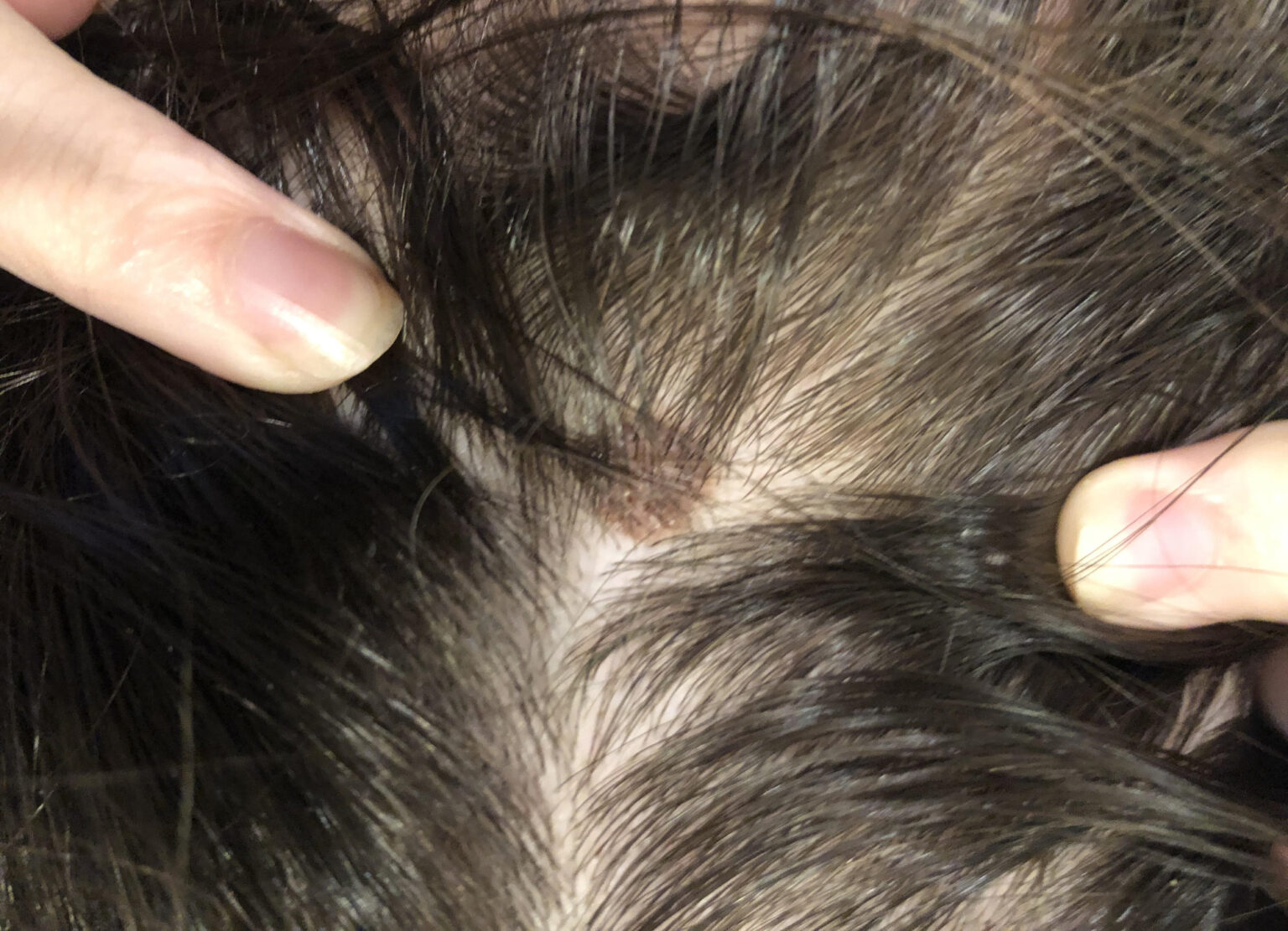 skin-cancer-spots-on-scalp